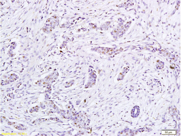 Formalin-fixed and paraffin embedded human tumor tissue labeled with Anti-HPV16-E6 Polyclonal Antibody, Unconjugated(bs-0990R) at 1:200, followed by conjugation to the secondary antibody and DAB staining