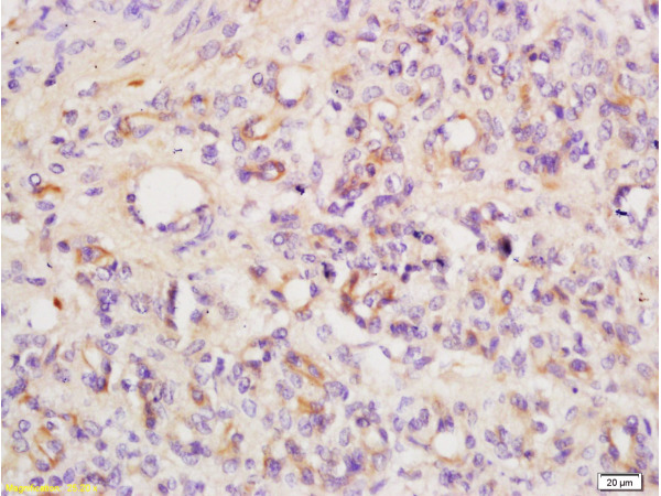 Formalin-fixed and paraffin embedded mouse tumor tissue labeled with Anti ANGPT3/ANG3/ANGPT4/ANG4 Polyclonal Antibody,Unconjugated (bs-1087R) at 1:200 followed by conjugation to the secondary antibody and DAB staining. Formalin-fixed and paraffin embedded mouse tumor tissue labeled with Anti ANGPT3/ANG3/ANGPT4/ANG4 Polyclonal Antibody,Unconjugated (bs-1087R) at 1:200 followed by conjugation to the secondary antibody and DAB staining.
