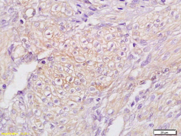 Formalin-fixed and paraffin embedded human endometrial carcinoma labeled with Anti TAP2/ABCB3 Polyclonal Antibody,Unconjugated (bs-2374R) at 1:200 followed by conjugation to the secondary antibody and DAB staining. Formalin-fixed and paraffin embedded human endometrial carcinoma labeled with Anti TAP2/ABCB3 Polyclonal Antibody,Unconjugated (bs-2374R) at 1:200 followed by conjugation to the secondary antibody and DAB staining.