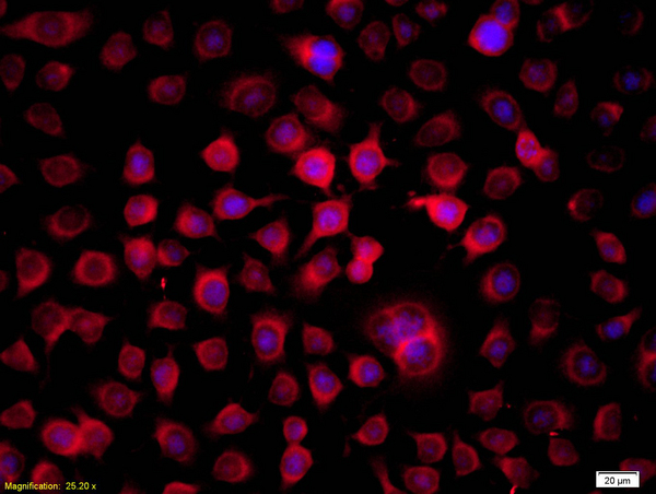 Squamous cell carcinoma stained with Anti-THRSP (bs-6738R)