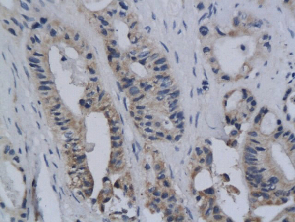 Formalin-fixed and paraffin embedded human colon cancer labeled with Anti-ROS/C ROS Polyclonal Antibody, Unconjugated (bs-2504R) followed by conjugation to the secondary antibody