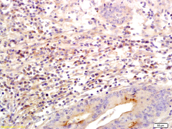 Formalin-fixed and paraffin embedded human colon labeled with Anti SLC26A4 Polyclonal Antibody, Unconjugated (bs-6787R) followed by conjugation to the secondary antibody and DAB staining