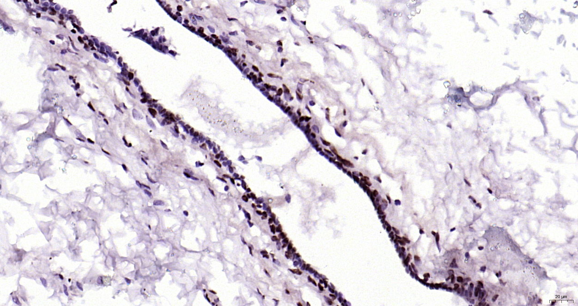 Paraformaldehyde-fixed, paraffin embedded Human breast; Antigen retrieval by boiling in sodium citrate buffer (pH6.0) for 15min; Block endogenous peroxidase by 3% hydrogen peroxide for 20 minutes; Blocking buffer (normal goat serum) at 37°C for 30min; Antibody incubation with YAP1(Tyr407) Polyclonal Antibody, Unconjugated (bs-3476R) at 1:200 overnight at 4°C, DAB staining.