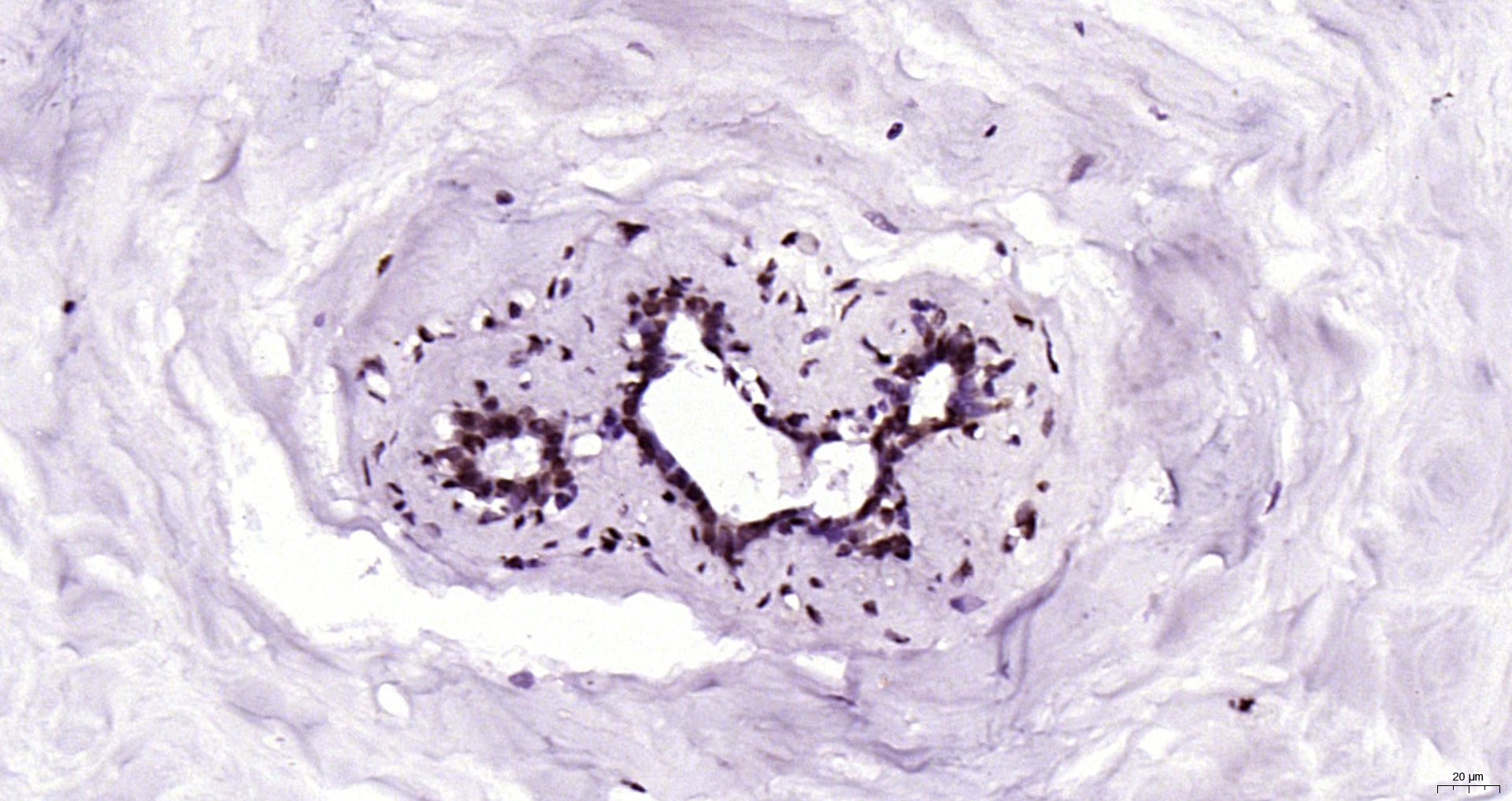 Paraformaldehyde-fixed, paraffin embedded Human breast cancer; Antigen retrieval by boiling in sodium citrate buffer (pH6.0) for 15min; Block endogenous peroxidase by 3% hydrogen peroxide for 20 minutes; Blocking buffer (normal goat serum) at 37°C for 30min; Antibody incubation with YAP1(Tyr407) Polyclonal Antibody, Unconjugated (bs-3476R) at 1:200 overnight at 4°C, DAB staining.