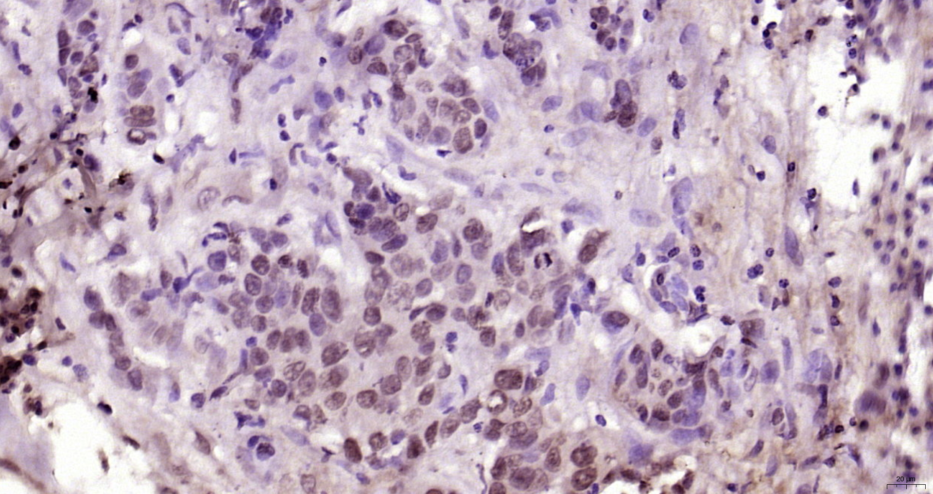 Paraformaldehyde-fixed, paraffin embedded Human esophageal carcinoma; Antigen retrieval by boiling in sodium citrate buffer (pH6.0) for 15min; Block endogenous peroxidase by 3% hydrogen peroxide for 20 minutes; Blocking buffer (normal goat serum) at 37°C for 30min; Antibody incubation with YAP1(Tyr407) Polyclonal Antibody, Unconjugated (bs-3476R) at 1:200 overnight at 4°C, DAB staining.