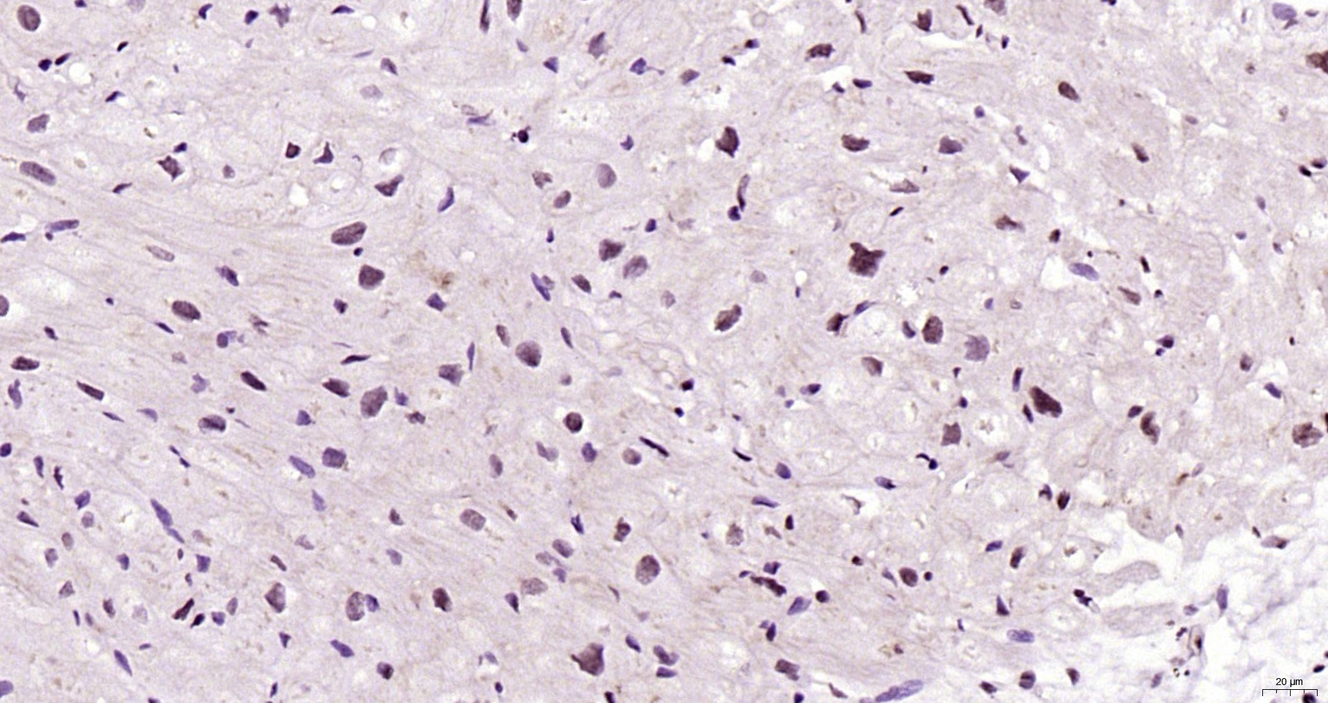 Paraformaldehyde-fixed, paraffin embedded Human heart; Antigen retrieval by boiling in sodium citrate buffer (pH6.0) for 15min; Block endogenous peroxidase by 3% hydrogen peroxide for 20 minutes; Blocking buffer (normal goat serum) at 37°C for 30min; Antibody incubation with Titin Polyclonal Antibody, Unconjugated (bs-9861R) at 1:200 overnight at 4°C, DAB staining. Paraformaldehyde-fixed, paraffin embedded Human heart; Antigen retrieval by boiling in sodium citrate buffer (pH6.0) for 15min; Block endogenous peroxidase by 3% hydrogen peroxide for 20 minutes; Blocking buffer (normal goat serum) at 37°C for 30min; Antibody incubation with Titin Polyclonal Antibody, Unconjugated (bs-9861R) at 1:200 overnight at 4°C, DAB staining.