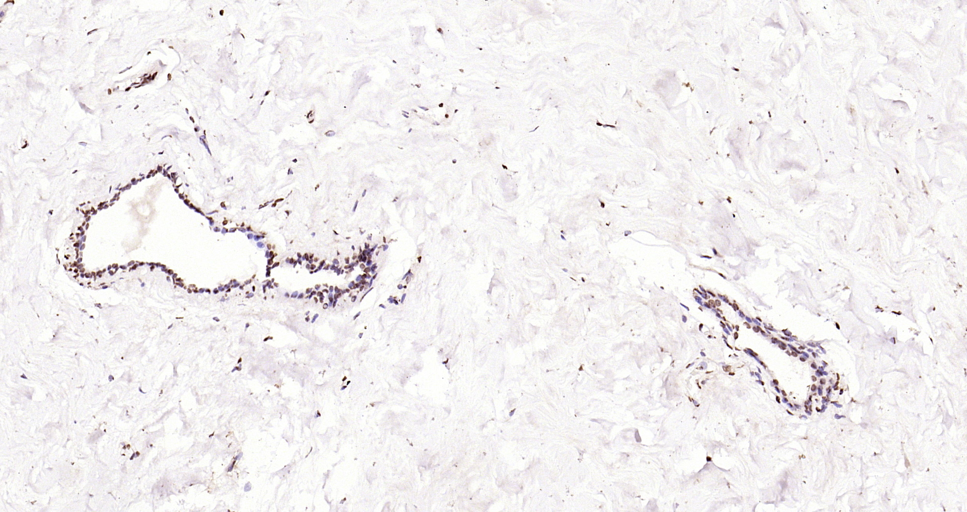Paraformaldehyde-fixed, paraffin embedded Human breast cancer; Antigen retrieval by boiling in sodium citrate buffer (pH6.0) for 15min; Block endogenous peroxidase by 3% hydrogen peroxide for 20 minutes; Blocking buffer (normal goat serum) at 37°C for 30min; Antibody incubation with ATF4/CREB-2 Polyclonal Antibody, Unconjugated (bs-1531R) at 1:200 overnight at 4°C, DAB staining.