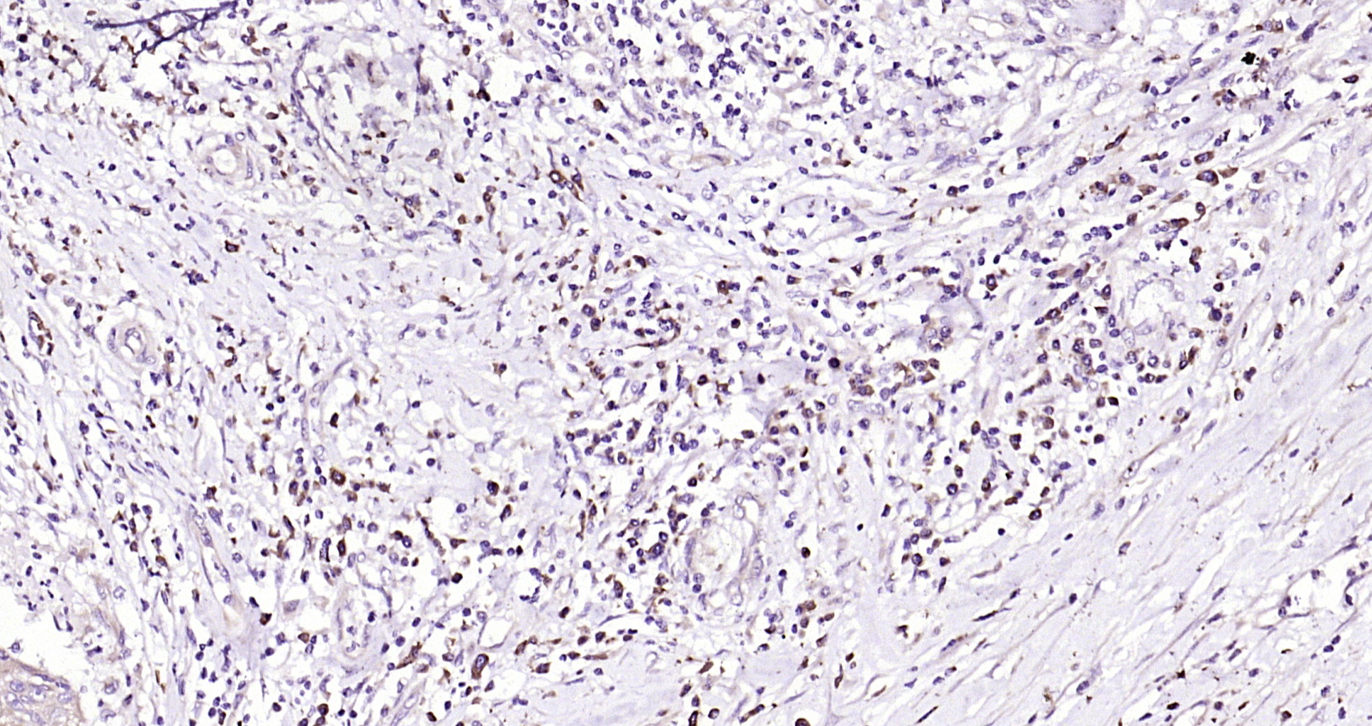 Paraformaldehyde-fixed, paraffin embedded Human esophageal carcinoma; Antigen retrieval by boiling in sodium citrate buffer (pH6.0) for 15min; Block endogenous peroxidase by 3% hydrogen peroxide for 20 minutes; Blocking buffer (normal goat serum) at 37°C for 30min; Antibody incubation with TLR4 Polyclonal Antibody, Unconjugated (bs-1021R) at 1:200 overnight at 4°C, DAB staining.