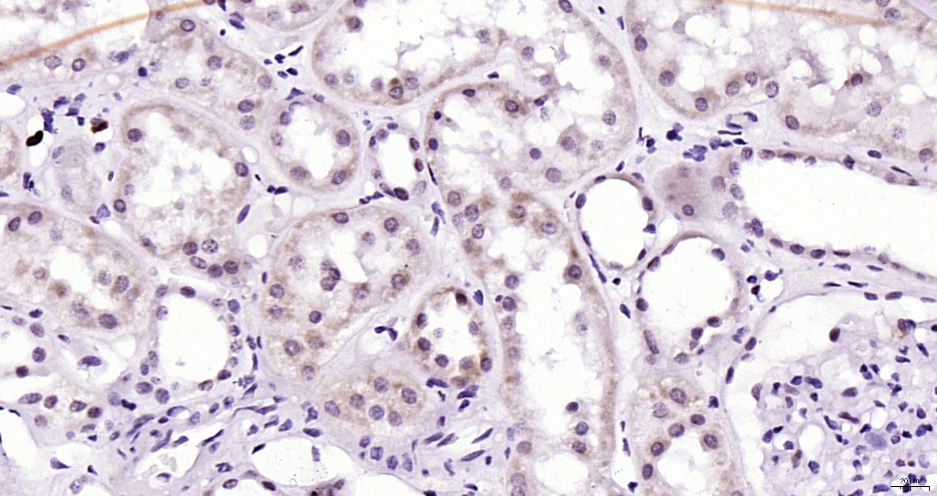 Paraformaldehyde-fixed, paraffin embedded Human kidney; Antigen retrieval by boiling in sodium citrate buffer (pH6.0) for 15min; Block endogenous peroxidase by 3% hydrogen peroxide for 20 minutes; Blocking buffer (normal goat serum) at 37°C for 30min; Antibody incubation with ATM (12A) Monoclonal Antibody, Unconjugated (bsm-52360R) at 1:200 overnight at 4°C, DAB staining.