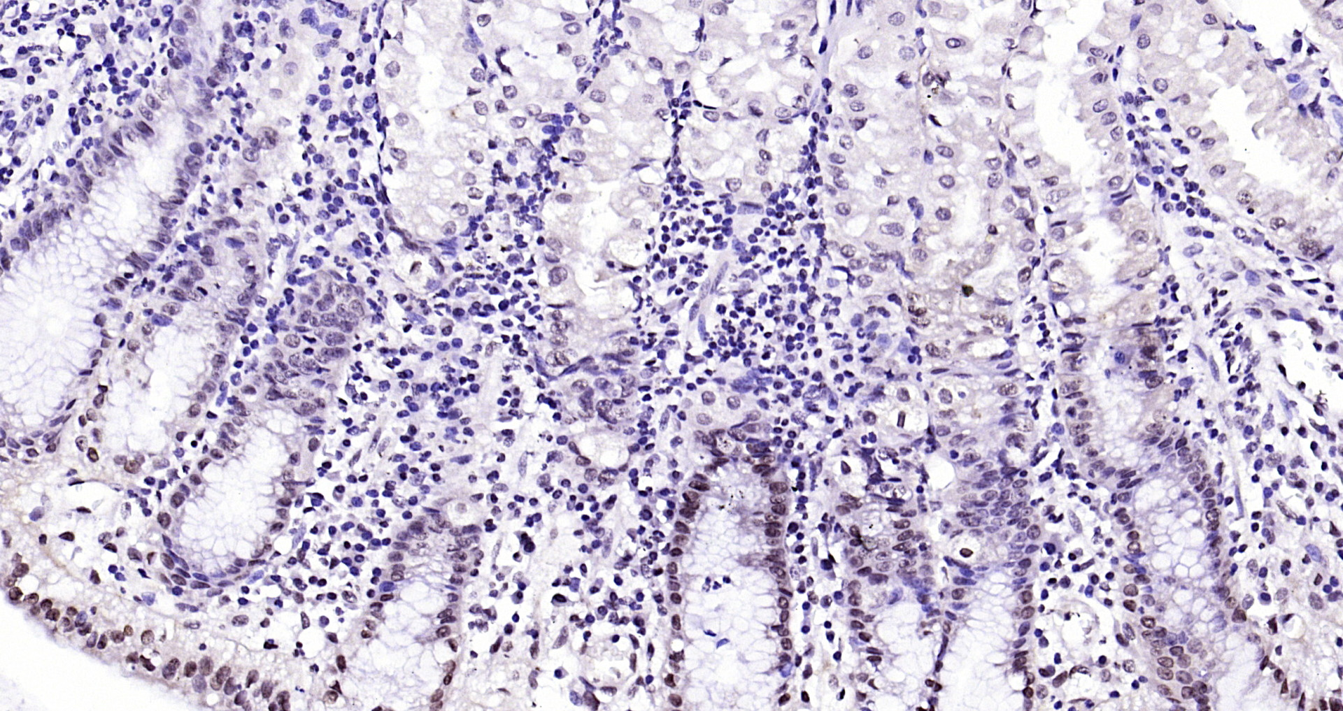 Paraformaldehyde-fixed, paraffin embedded Human stomach; Antigen retrieval by boiling in sodium citrate buffer (pH6.0) for 15min; Block endogenous peroxidase by 3% hydrogen peroxide for 20 minutes; Blocking buffer (normal goat serum) at 37°C for 30min; Antibody incubation with CIDEC Polyclonal Antibody, Unconjugated (bs-6796R) at 1:200 overnight at 4°C, DAB staining.