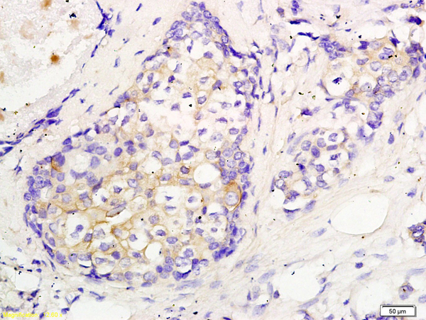 Formalin-fixed and paraffin embedded human breast cancer labeled with Anti CEP55 Polyclonal Antibody, Unconjugated (bs-7742R) followed by conjugation to the secondary antibody and DAB staining