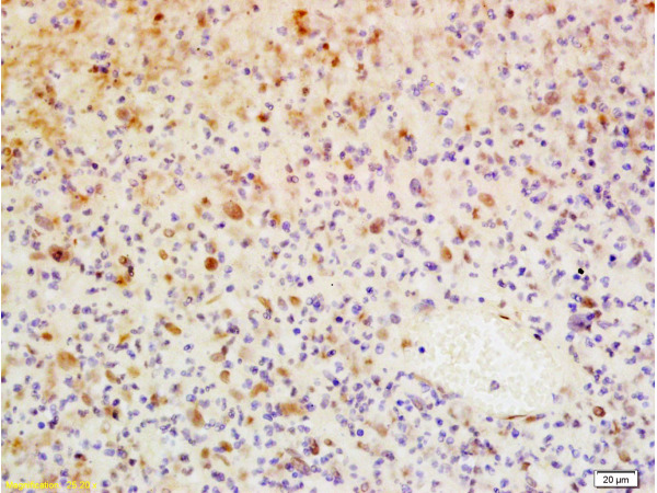 Formalin-fixed and paraffin embedded human glioma tissue labeled with Anti-WIG-1/PAG608 Polyclonal Antibody, Unconjugated (bs-0942R) at 1:200, followed by conjugation to the secondary antibody and DAB staining