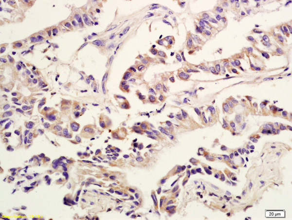 Formalin-fixed and paraffin embedded human colon cancer labeled with Anti Amphiregulin Polyclonal Antibody, Unconjugated (bs-3847R) at 1:600 followed by conjugation to the secondary antibody and DAB staining