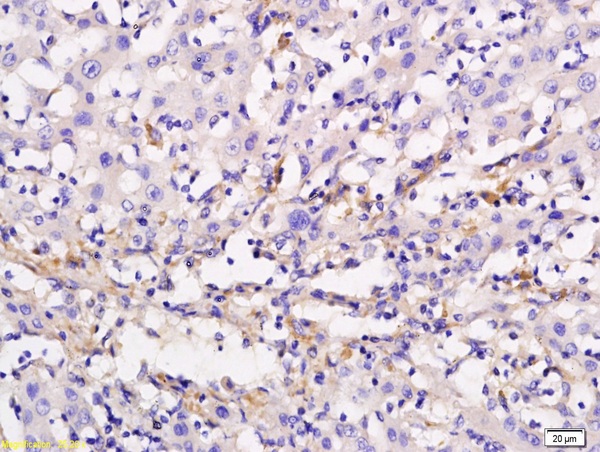 Formalin-fixed and paraffin embedded human liver cancer labeled with Anti ADCY10 Polyclonal Antibody, Unconjugated (bs-3916R) followed by conjugation to the secondary antibody and DAB staining