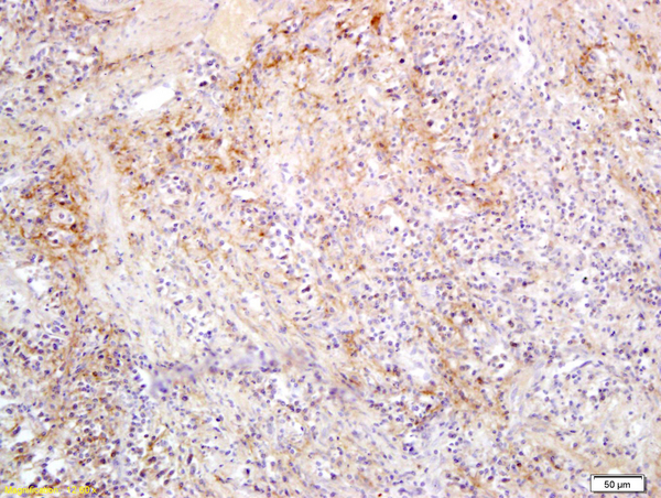 Formalin-fixed and paraffin embedded human colorectal cancer labeled with Anti SLC27A2 Polyclonal Antibody, Unconjugated (bs-3936R) followed by conjugation to the secondary antibody and DAB staining