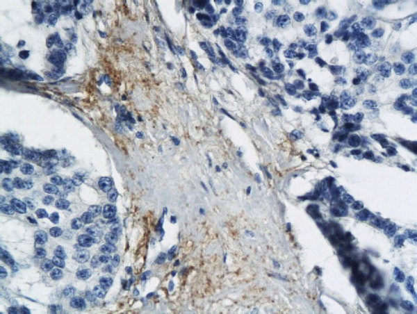 Formalin-fixed and paraffin embedded human breast cancer labeled with Anti MT-ND6 Polyclonal Antibody, Unconjugated (bs-3955R) followed by conjugation to the secondary antibody and DAB staining