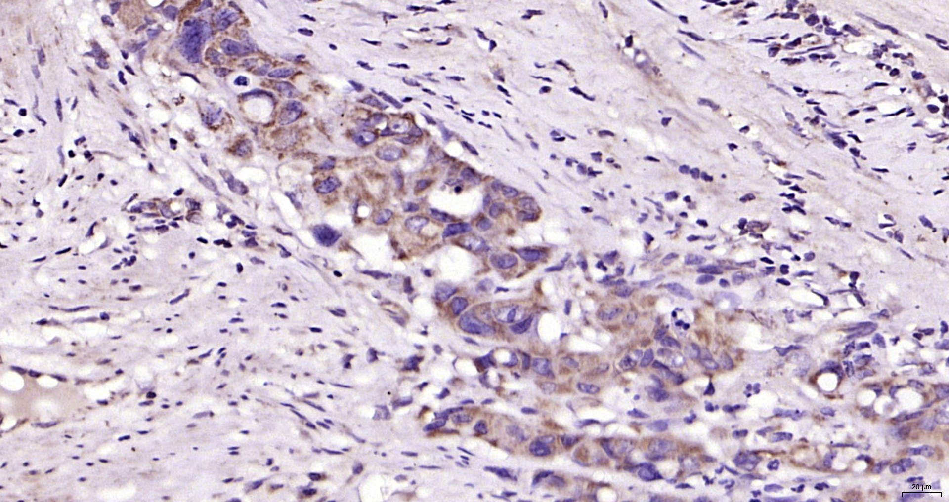 Paraformaldehyde-fixed, paraffin embedded Human colon cancer; Antigen retrieval by boiling in sodium citrate buffer (pH6.0) for 15min; Block endogenous peroxidase by 3% hydrogen peroxide for 20 minutes; Blocking buffer (normal goat serum) at 37°C for 30min; Antibody incubation with TRIAD3 Polyclonal Antibody, Unconjugated (bs-9154R) at 1:200 overnight at 4°C, DAB staining.