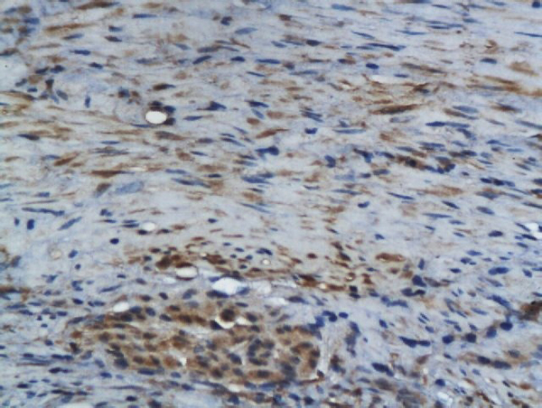 Formalin-fixed and paraffin embedded human colon carcinoma labeled with Rabbit Anti GM-CSF Polyclonal Antibody, Unconjugated (bs-3790R) at 1:200 followed by conjugation to the secondary antibody and DAB staining