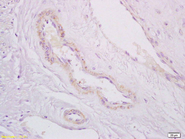 Formalin-fixed and paraffin embedded human cervical carcinoma labeled with Anti-PDE5A Polyclonal Antibody, Unconjugated(bs-2349R) at 1:200 followed by conjugation to the secondary antibody
