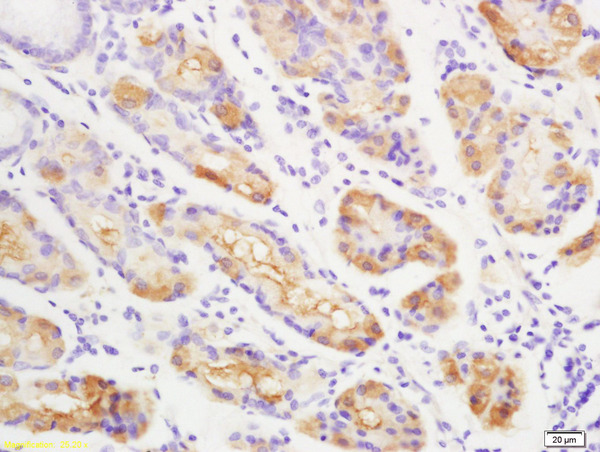 Formalin-fixed and paraffin embedded human gastric carcinoma labeled with Anti-Anei-ATX/Autotaxin Polyclonal Antibody, Unconjugated (bs-2437R) at 1:200 followed by conjugation to the secondary antibody Formalin-fixed and paraffin embedded human gastric carcinoma labeled with Anti-Anei-ATX/Autotaxin Polyclonal Antibody, Unconjugated (bs-2437R) at 1:200 followed by conjugation to the secondary antibody