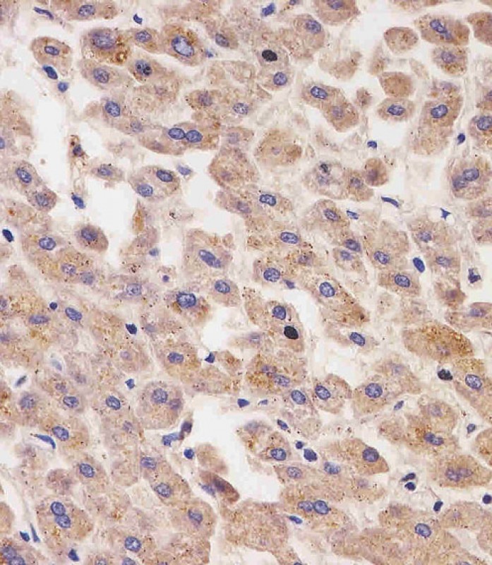 Paraformaldehyde-fixed, paraffin embedded Human liver; Antigen retrieval by boiling in sodium citrate buffer (pH6.0) for 15min; Block endogenous peroxidase by 3% hydrogen peroxide for 20 minutes; Blocking buffer (normal goat serum) at 37°C for 30min; Antibody incubation with AFP Monoclonal Antibody, Unconjugated (bsm-51467M) at 1:25 overnight at 4°C, DAB staining.
