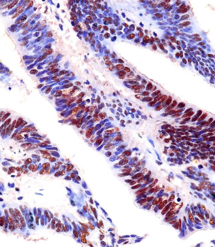Paraformaldehyde-fixed, paraffin embedded Human colon cancer; Antigen retrieval by boiling in sodium citrate buffer (pH6.0) for 15min; Block endogenous peroxidase by 3% hydrogen peroxide for 20 minutes; Blocking buffer (normal goat serum) at 37°C for 30min; Antibody incubation with EZH2 Monoclonal Antibody, Unconjugated (bsm-51468M) at 1:25 overnight at 4°C, DAB staining.