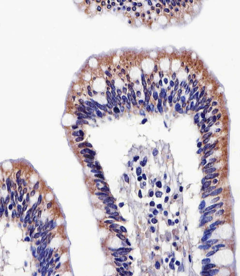 Paraformaldehyde-fixed, paraffin embedded Human colon; Antigen retrieval by boiling in sodium citrate buffer (pH6.0) for 15min; Block endogenous peroxidase by 3% hydrogen peroxide for 20 minutes; Blocking buffer (normal goat serum) at 37°C for 30min; Antibody incubation with ALDH6A1 Monoclonal Antibody, Unconjugated (bsm-51469M) at 1:25 overnight at 4°C, DAB staining.