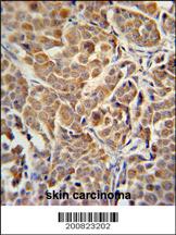 Paraformaldehyde-fixed, paraffin embedded Human skin cancer; Antigen retrieval by boiling in sodium citrate buffer (pH6.0) for 15min; Block endogenous peroxidase by 3% hydrogen peroxide for 20 minutes; Blocking buffer (normal goat serum) at 37°C for 30min; Antibody incubation with ALDH3A2 Monoclonal Antibody, Unconjugated (bsm-51470M) at 1:200 overnight at 4°C, DAB staining.