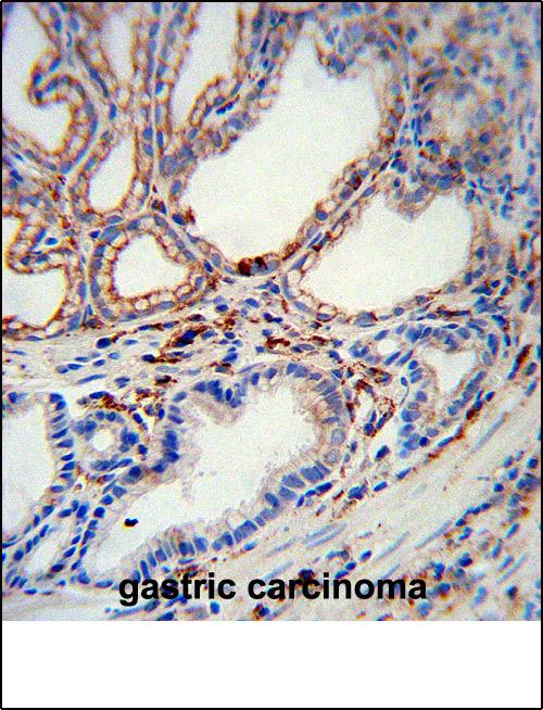 Paraformaldehyde-fixed, paraffin embedded Human gastric carcinoma; Antigen retrieval by boiling in sodium citrate buffer (pH6.0) for 15min; Block endogenous peroxidase by 3% hydrogen peroxide for 20 minutes; Blocking buffer (normal goat serum) at 37°C for 30min; Antibody incubation with MMP2 Monoclonal Antibody, Unconjugated (bsm-51472M) at 1:200 overnight at 4°C, DAB staining.