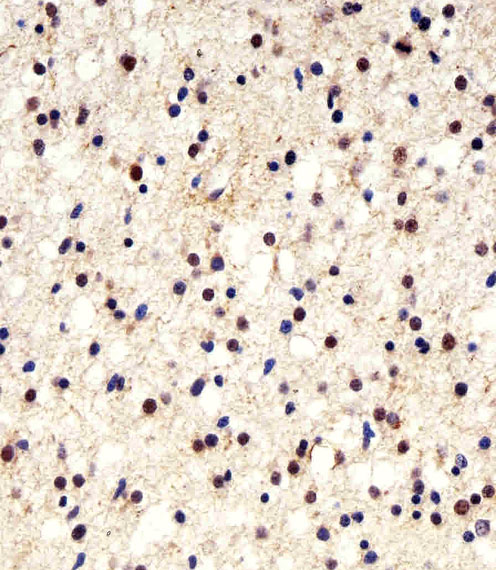Paraformaldehyde-fixed, paraffin embedded Human astroglioma; Antigen retrieval by boiling in sodium citrate buffer (pH6.0) for 15min; Block endogenous peroxidase by 3% hydrogen peroxide for 20 minutes; Blocking buffer (normal goat serum) at 37\u00b0C for 30min; Antibody incubation with UCHL1\/PGP9.5 Monoclonal Antibody, Unconjugated (bsm-51558M) at 1:25 overnight at 4\u00b0C, DAB staining.