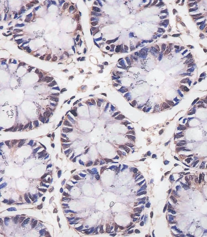 Paraformaldehyde-fixed, paraffin embedded Human colon; Antigen retrieval by boiling in sodium citrate buffer (pH6.0) for 15min; Block endogenous peroxidase by 3% hydrogen peroxide for 20 minutes; Blocking buffer (normal goat serum) at 37°C for 30min; Antibody incubation with MBD2 Monoclonal Antibody, Unconjugated (bsm-51671M) at 1:25 overnight at 4°C, DAB staining. Paraformaldehyde-fixed, paraffin embedded Human colon; Antigen retrieval by boiling in sodium citrate buffer (pH6.0) for 15min; Block endogenous peroxidase by 3% hydrogen peroxide for 20 minutes; Blocking buffer (normal goat serum) at 37°C for 30min; Antibody incubation with MBD2 Monoclonal Antibody, Unconjugated (bsm-51671M) at 1:25 overnight at 4°C, DAB staining.