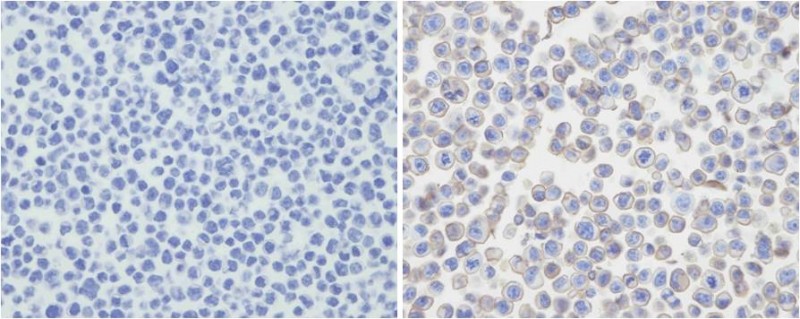 Immunohistochemical analysis of PDCD1LG2 in untransfected(left) or transfected(right) with 293T cell sections. Cell was fixed with formaldehyde; antigen retrieval was by heat mediation with a EDTA buffer (pH9. 0). Samples were incubated with primary antibody (1:25) for 1 hours at room temperature. A undiluted biotinylated goat polyvalent antibody was used as the secondary antibody.