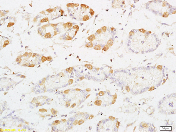 Formalin-fixed and paraffin embedded human colon carcinoma labeled with Anti-PRKD3 Polyclonal Antibody, Unconjugated (bs-4157R) at 1:200 followed by conjugation to the secondary antibody and DAB staining
