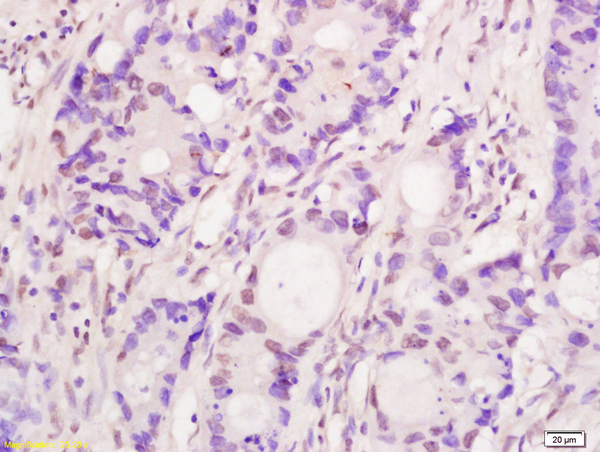 Formalin-fixed and paraffin embedded human colon carcinoma labeled with Anti-Bub1 Polyclonal Antibody, Unconjugated (bs-4294R) at 1:200 followed by conjugation to the secondary antibody and DAB staining