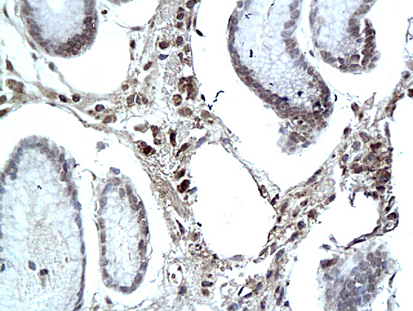 Formalin-fixed and paraffin embedded human colon labeled with Rabbit Anti eIF3F Polyclonal Antibody, Unconjugated (bs-3841R) at 1:200 followed by conjugation to the secondary antibody and DAB staining