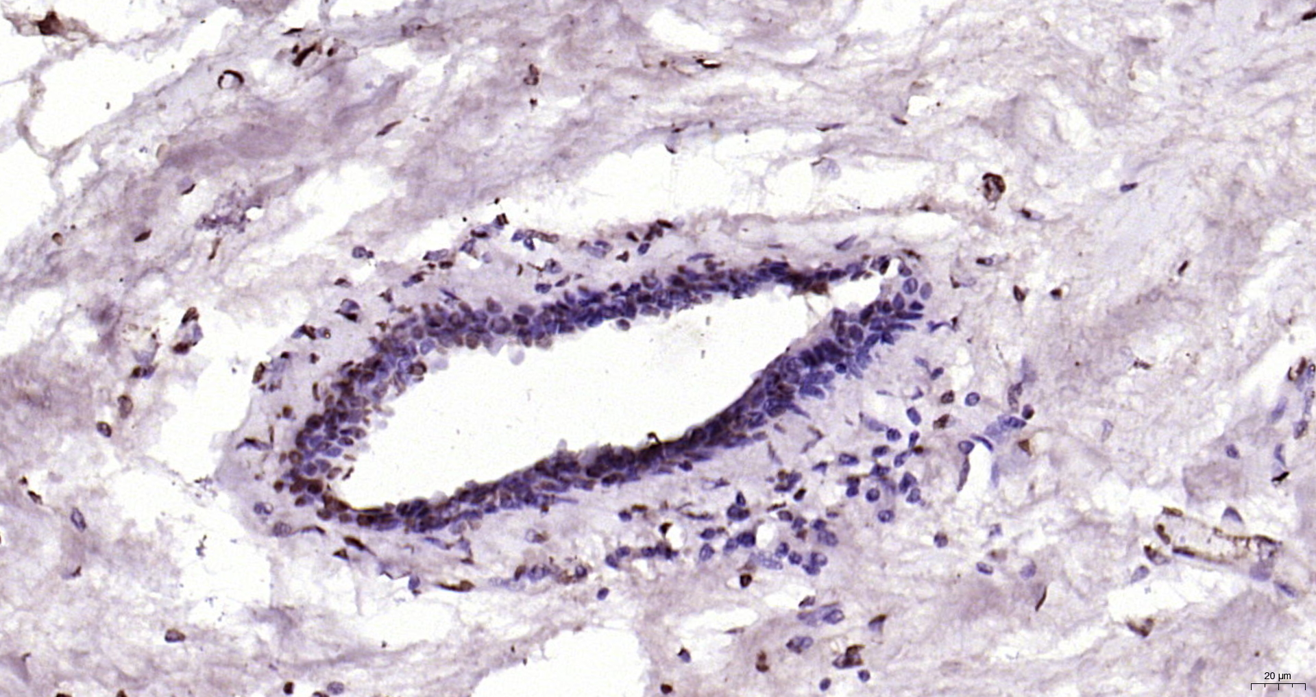 Paraformaldehyde-fixed, paraffin embedded Human breast cancer; Antigen retrieval by boiling in sodium citrate buffer (pH6.0) for 15min; Block endogenous peroxidase by 3% hydrogen peroxide for 20 minutes; Blocking buffer (normal goat serum) at 37°C for 30min; Antibody incubation with CDKN1A Polyclonal Antibody, Unconjugated (bs-0741R) at 1:200 overnight at 4°C, DAB staining.