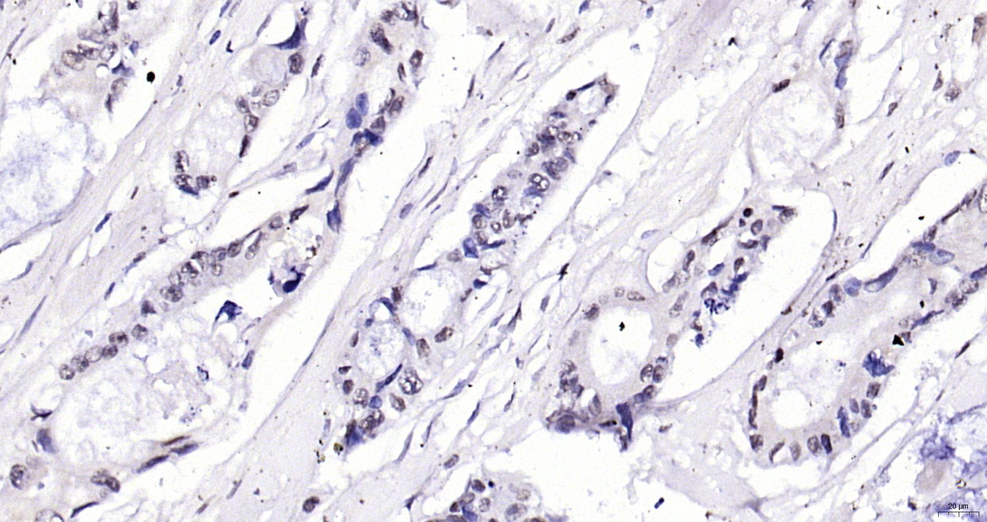 Paraformaldehyde-fixed, paraffin embedded Human cervical cancer; Antigen retrieval by boiling in sodium citrate buffer (pH6.0) for 15min; Block endogenous peroxidase by 3% hydrogen peroxide for 20 minutes; Blocking buffer (normal goat serum) at 37°C for 30min; Antibody incubation with eIF4G Polyclonal Antibody, Unconjugated (bs-3843R) at 1:200 overnight at 4°C, DAB staining.