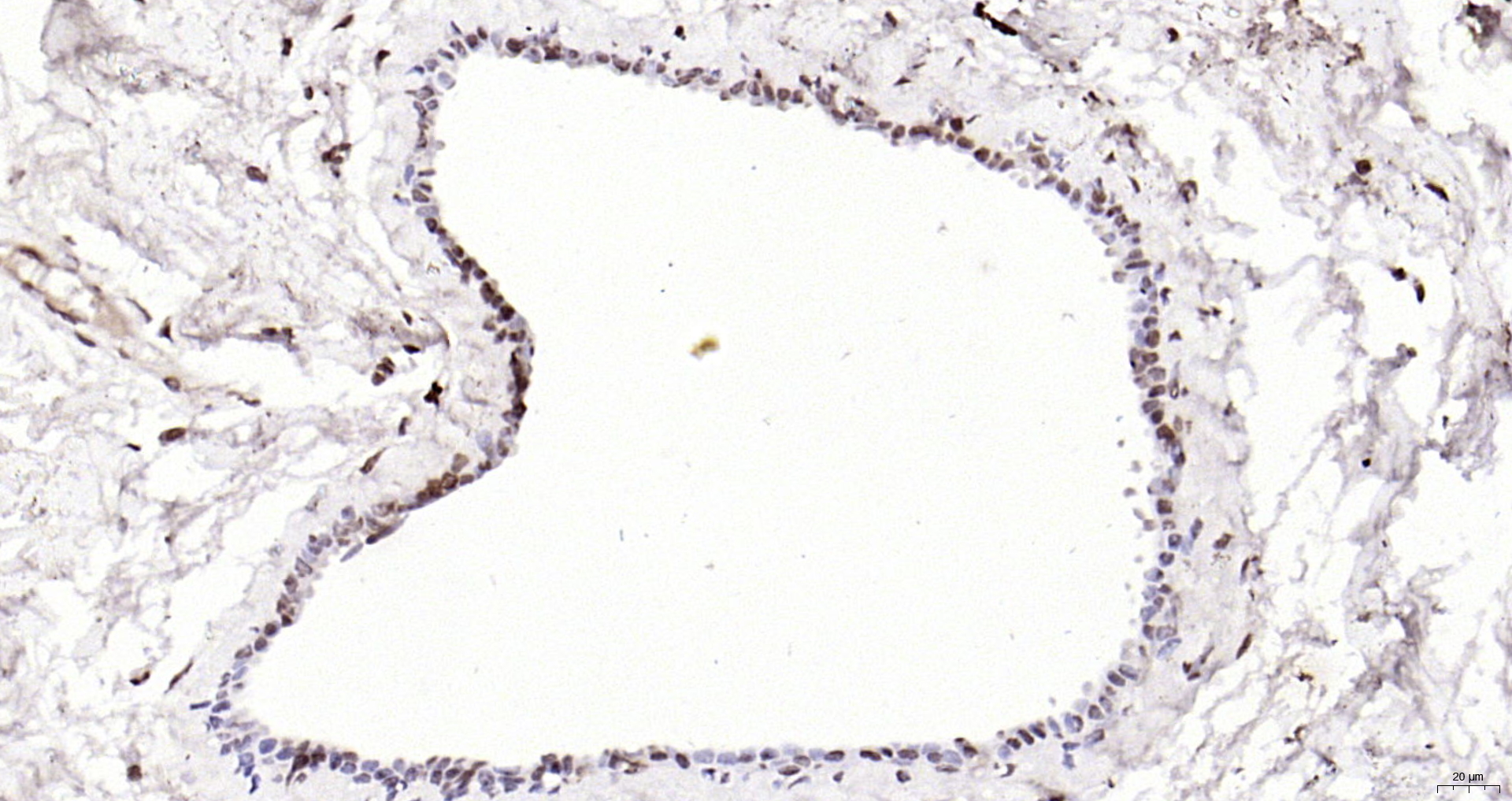 Paraformaldehyde-fixed, paraffin embedded Human breast cancer; Antigen retrieval by boiling in sodium citrate buffer (pH6.0) for 15min; Block endogenous peroxidase by 3% hydrogen peroxide for 20 minutes; Blocking buffer (normal goat serum) at 37°C for 30min; Antibody incubation with eIF4G Polyclonal Antibody, Unconjugated (bs-3843R) at 1:200 overnight at 4°C, DAB staining.