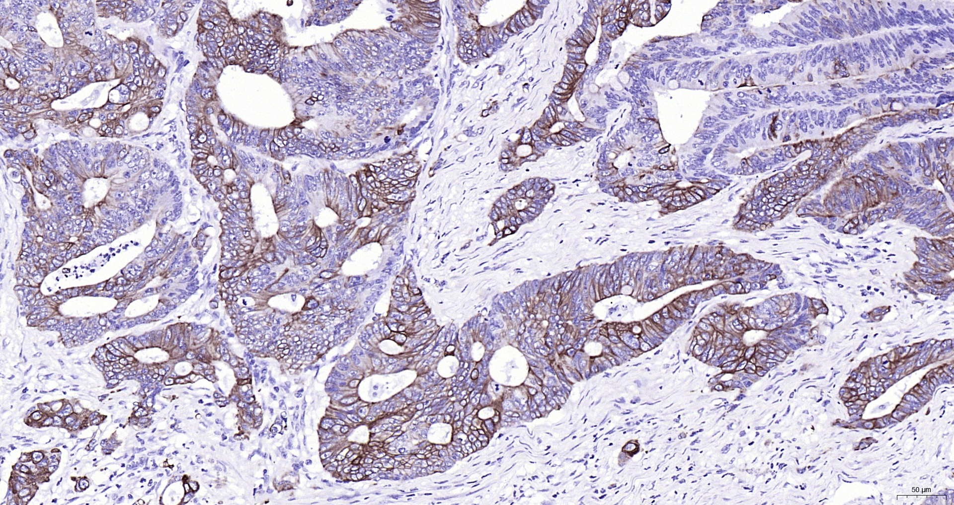 Paraformaldehyde-fixed, paraffin embedded Human colon cancer; Antigen retrieval by boiling in sodium citrate buffer (pH6.0) for 15min; Block endogenous peroxidase by 3% hydrogen peroxide for 20 minutes; Blocking buffer (normal goat serum) at 37°C for 30min; Antibody incubation with Cytokeratin 20 (1F10) Monoclonal Antibody, Unconjugated (bsm-52060R) at 1:200 overnight at 4°C, DAB staining.