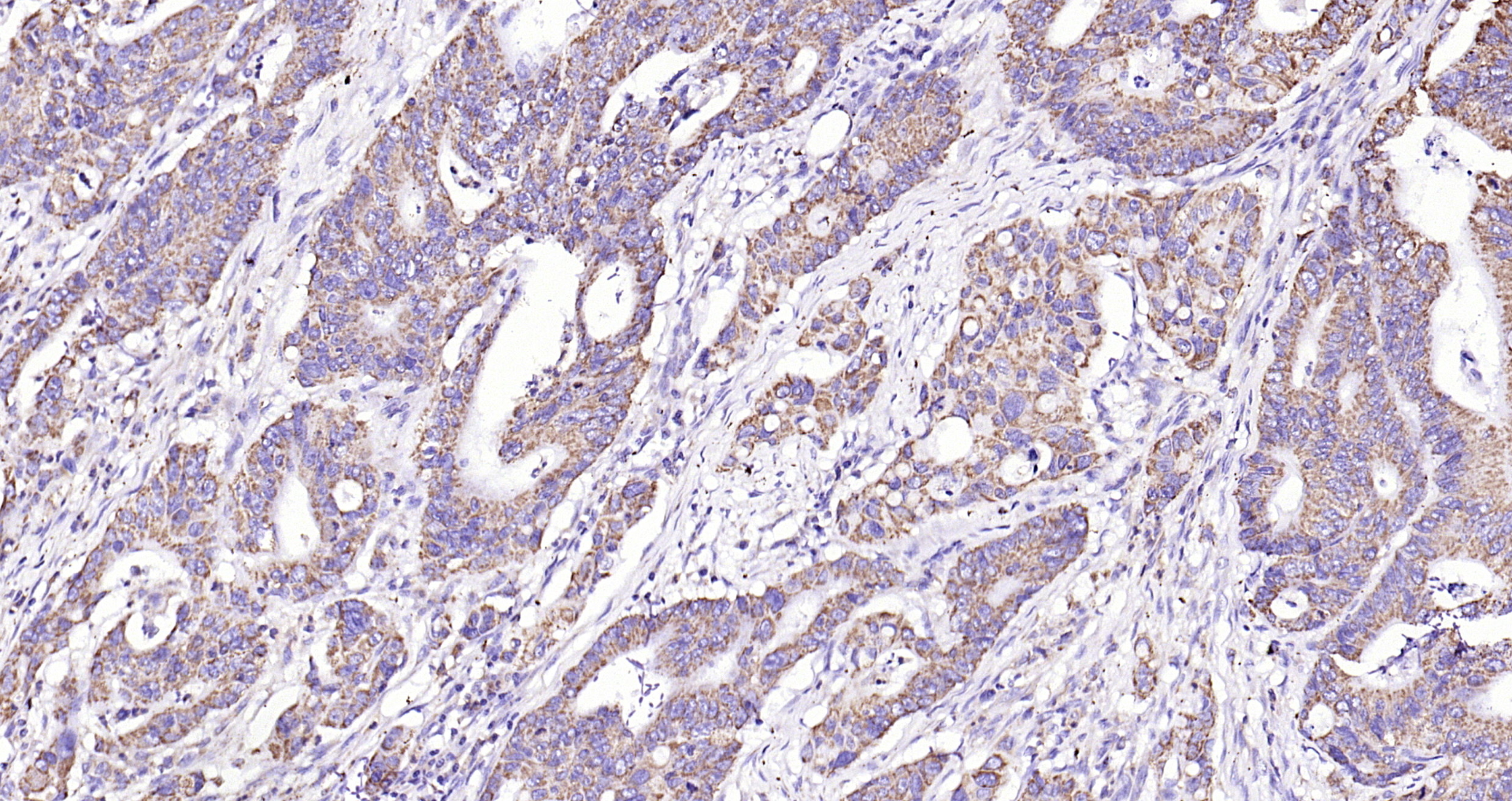 Paraformaldehyde-fixed, paraffin embedded Human colon cancer; Antigen retrieval by boiling in sodium citrate buffer (pH6.0) for 15min; Block endogenous peroxidase by 3% hydrogen peroxide for 20 minutes; Blocking buffer (normal goat serum) at 37°C for 30min; Antibody incubation with RASSF2 Polyclonal Antibody, Unconjugated (bs-2939R) at 1:200 overnight at 4°C, DAB staining. Paraformaldehyde-fixed, paraffin embedded Human colon cancer; Antigen retrieval by boiling in sodium citrate buffer (pH6.0) for 15min; Block endogenous peroxidase by 3% hydrogen peroxide for 20 minutes; Blocking buffer (normal goat serum) at 37°C for 30min; Antibody incubation with RASSF2 Polyclonal Antibody, Unconjugated (bs-2939R) at 1:200 overnight at 4°C, DAB staining.