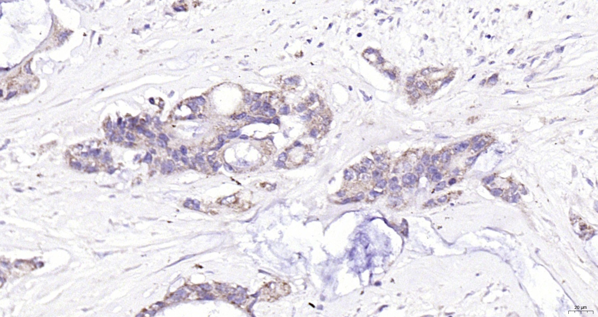 Paraformaldehyde-fixed, paraffin embedded Human cervical cancer; Antigen retrieval by boiling in sodium citrate buffer (pH6.0) for 15min; Block endogenous peroxidase by 3% hydrogen peroxide for 20 minutes; Blocking buffer (normal goat serum) at 37°C for 30min; Antibody incubation with EML4-ALK fusion protein(EML4) Polyclonal Antibody, Unconjugated (bs-24711R) at 1:200 overnight at 4°C, DAB staining.