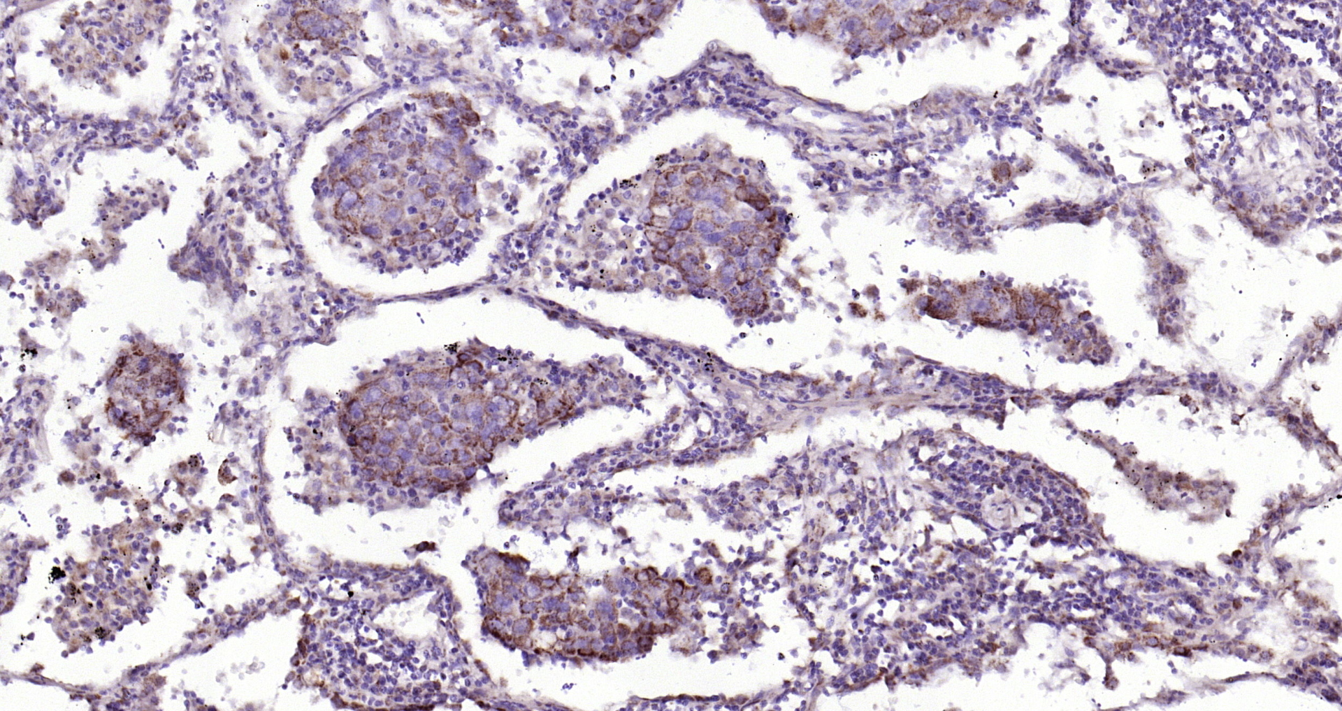 Paraformaldehyde-fixed, paraffin embedded Human lung cancer; Antigen retrieval by boiling in sodium citrate buffer (pH6.0) for 15min; Block endogenous peroxidase by 3% hydrogen peroxide for 20 minutes; Blocking buffer (normal goat serum) at 37°C for 30min; Antibody incubation with IKK alpha Polyclonal Antibody, Unconjugated (bs-2907R) at 1:200 overnight at 4°C, DAB staining.