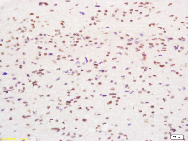 Formalin-fixed and paraffin embedded human glioma tissue labeled with Anti-Phospho-YB1(Ser102) Polyclonal Antibody, Unconjugated (bs-3477R) at 1:200 followed by conjugation to the secondary antibody and DAB staining