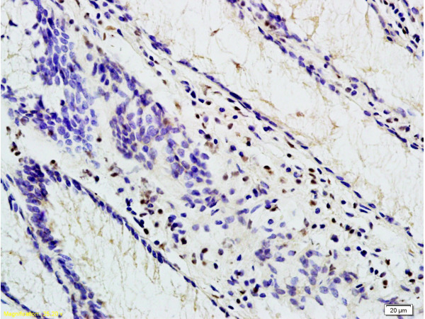 Formalin-fixed and paraffin embedded human colon carcinoma labeled with Anti-TBL1X Polyclonal Antibody, Unconjugated (bs-4219R)at 1:200 followed by conjugation to the secondary antibody and DAB staining