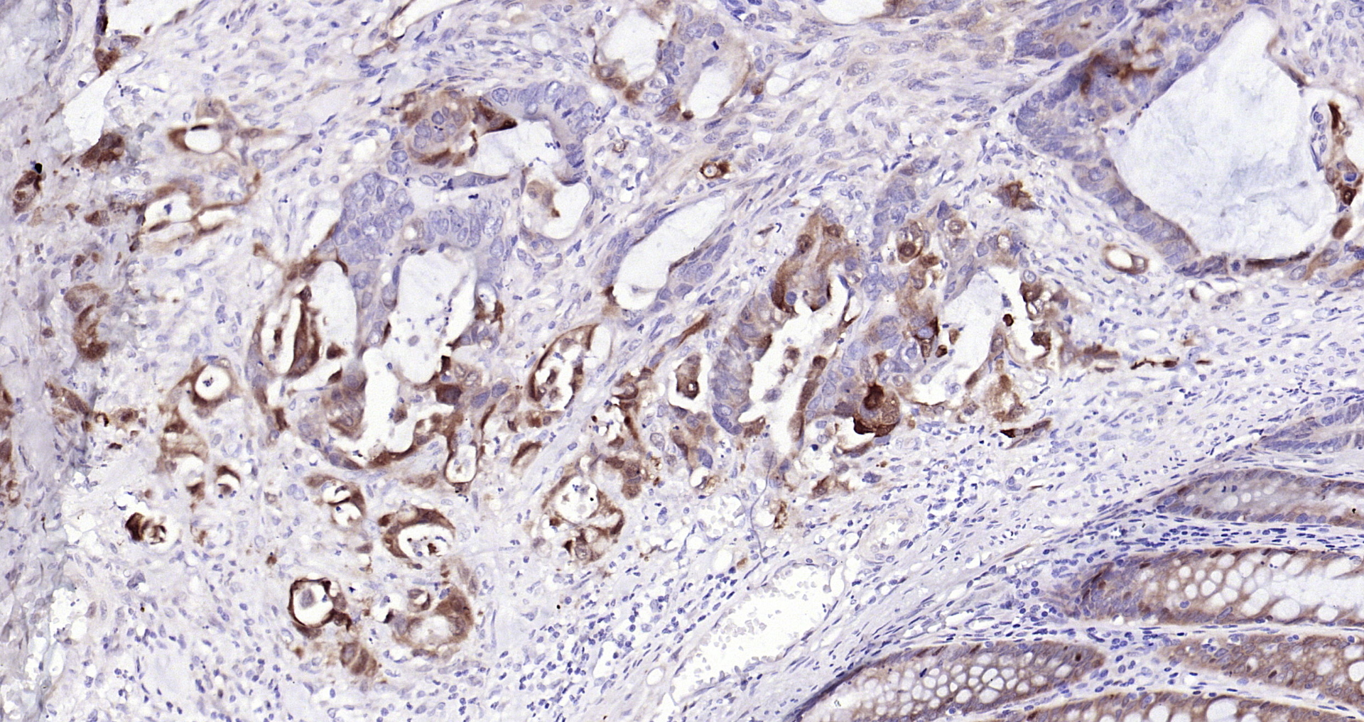 Paraformaldehyde-fixed, paraffin embedded Human colon cancer; Antigen retrieval by boiling in sodium citrate buffer (pH6.0) for 15min; Block endogenous peroxidase by 3% hydrogen peroxide for 20 minutes; Blocking buffer (normal goat serum) at 37°C for 30min; Antibody incubation with BST2 (1C3) Monoclonal Antibody, Unconjugated (bsm-54196R) at 1:200 overnight at 4°C, DAB staining.