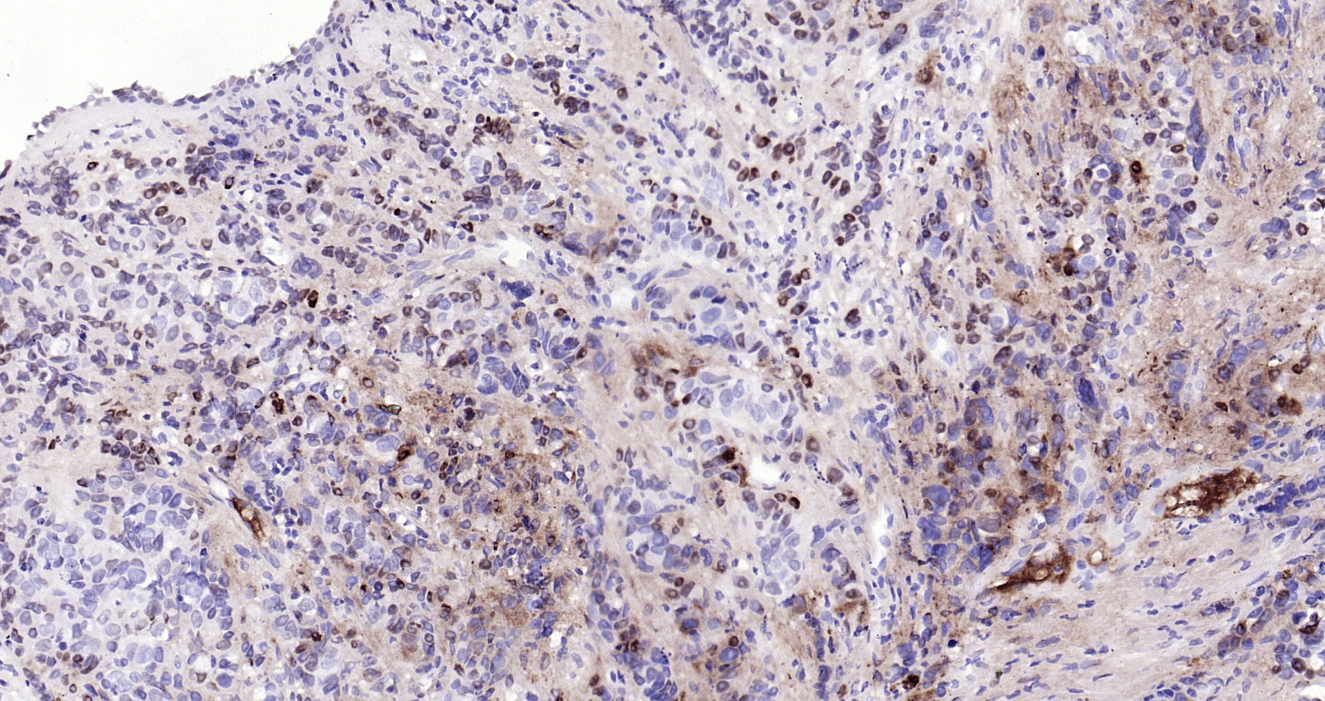 Paraformaldehyde-fixed, paraffin embedded Human breast cancer; Antigen retrieval by boiling in sodium citrate buffer (pH6.0) for 15min; Block endogenous peroxidase by 3% hydrogen peroxide for 20 minutes; Blocking buffer (normal goat serum) at 37°C for 30min; Antibody incubation with BST2 (1C3) Monoclonal Antibody, Unconjugated (bsm-54196R) at 1:200 overnight at 4°C, DAB staining.