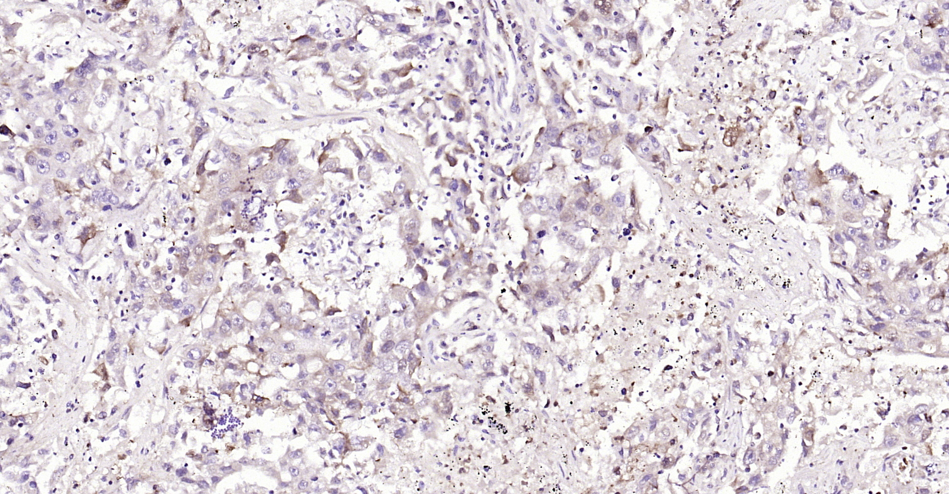 Paraformaldehyde-fixed, paraffin embedded Human lung cancer; Antigen retrieval by boiling in sodium citrate buffer (pH6.0) for 15min; Block endogenous peroxidase by 3% hydrogen peroxide for 20 minutes; Blocking buffer (normal goat serum) at 37°C for 30min; Antibody incubation with S100-A9 Polyclonal Antibody, Unconjugated (bs-2697R) at 1:200 overnight at 4°C, DAB staining.