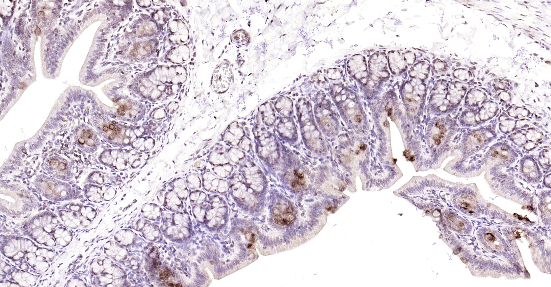 Paraformaldehyde-fixed, paraffin embedded Rat colon; Antigen retrieval by boiling in sodium citrate buffer (pH6.0) for 15min; Block endogenous peroxidase by 3% hydrogen peroxide for 20 minutes; Blocking buffer (normal goat serum) at 37°C for 30min; Antibody incubation with YB1(Ser102) Polyclonal Antibody, Unconjugated (bs-3477R) at 1:200 overnight at 4°C, DAB staining.