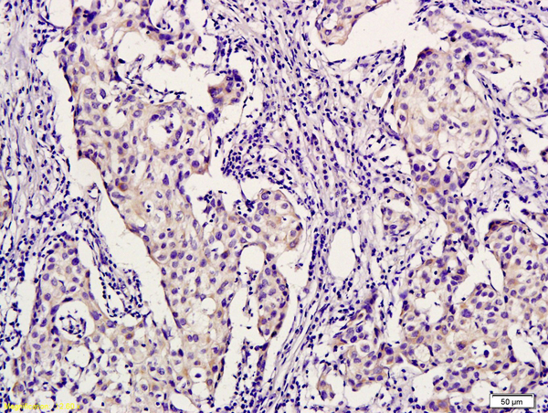 Formalin-fixed and paraffin embedded human breast cancer labeled with Anti-PHYH Polyclonal Antibody, Unconjugated (bs-5091R) followed by conjugation to the secondary antibody and DAB staining