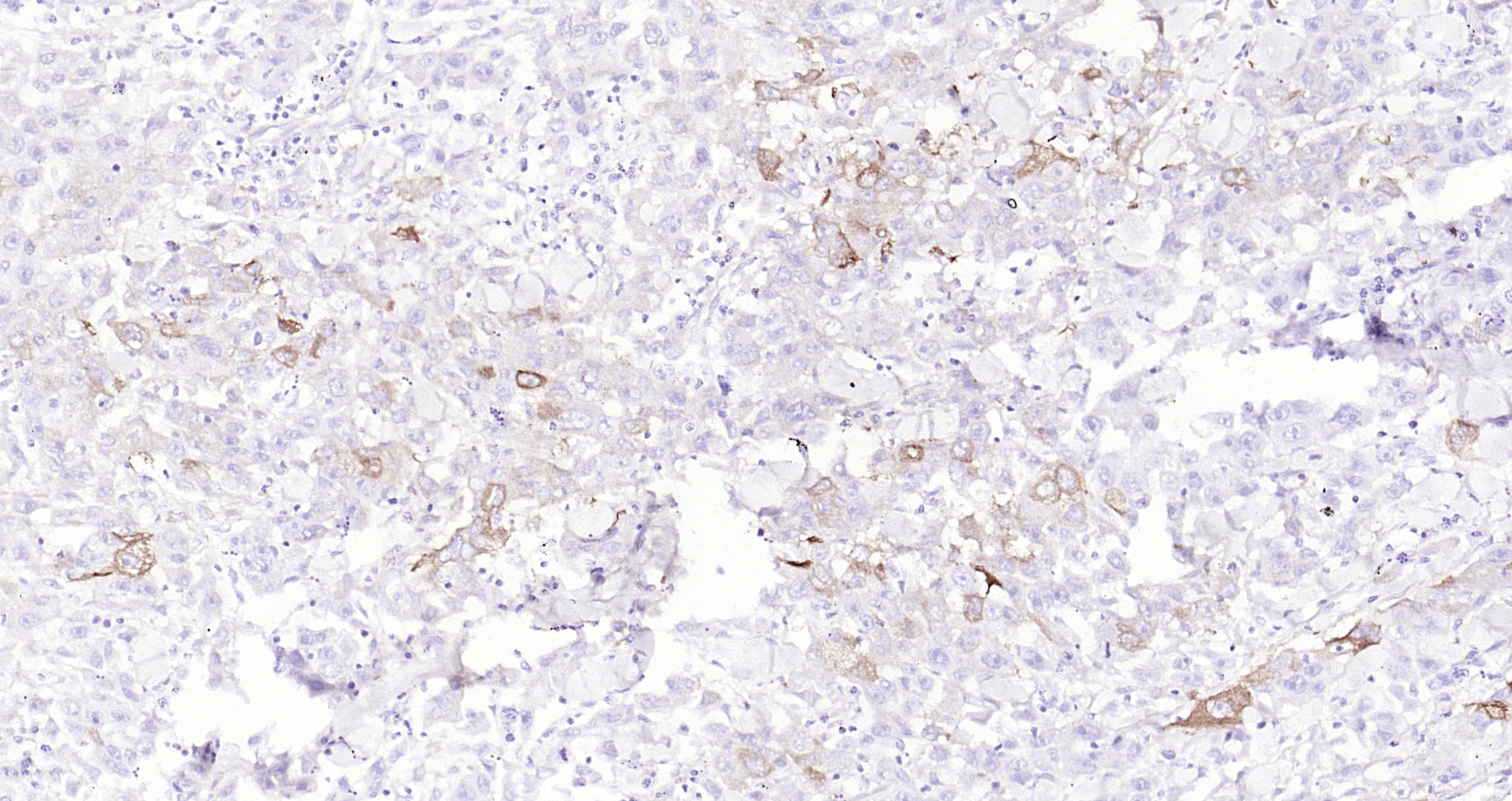 Paraformaldehyde-fixed, paraffin embedded Human lung cancer; Antigen retrieval by boiling in sodium citrate buffer (pH6.0) for 15min; Block endogenous peroxidase by 3% hydrogen peroxide for 20 minutes; Blocking buffer (normal goat serum) at 37°C for 30min; Antibody incubation with Glycogen synthase 1(S641) (10C1) Monoclonal Antibody, Unconjugated (bsm-52159R) at 1:200 overnight at 4°C, DAB staining.